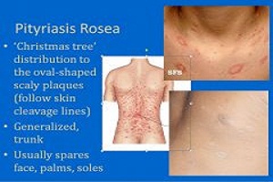How does pityriasis rosea work?